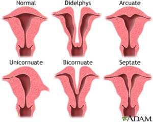 heart shaped uterus