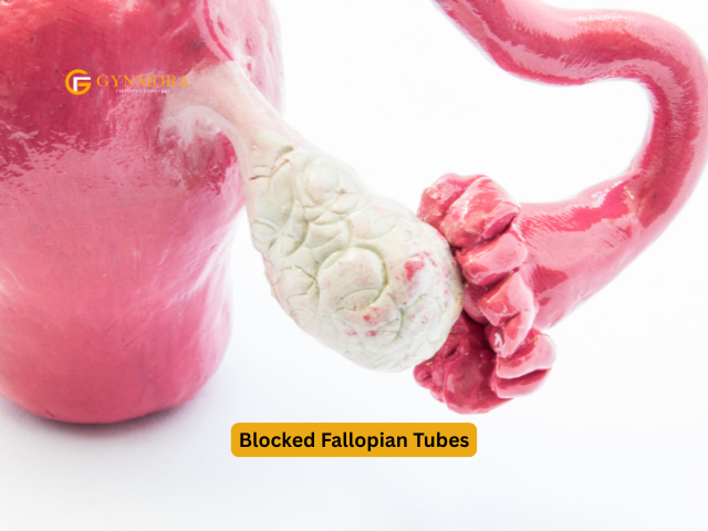 Blocked Fallopian Tubes