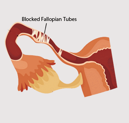 blocked fallopian tubes