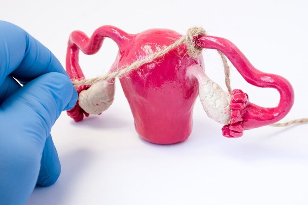 IVF After Tubal Ligation