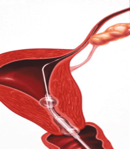 can you do IVF if your tubes are removed