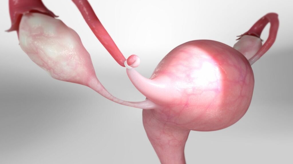 IVF After Tubal Ligation IVF After Tubal Ligation