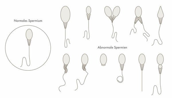 wunschkind_klinik_dr_brunbauer_grafik_speriogramm