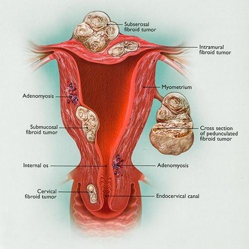 Hostile Uterus