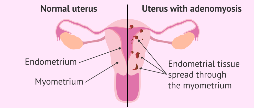 Hostile Uterus
